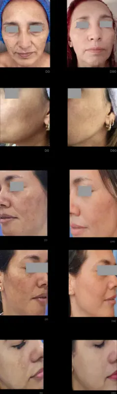 TRANACIX® Krem SPF20 30 g